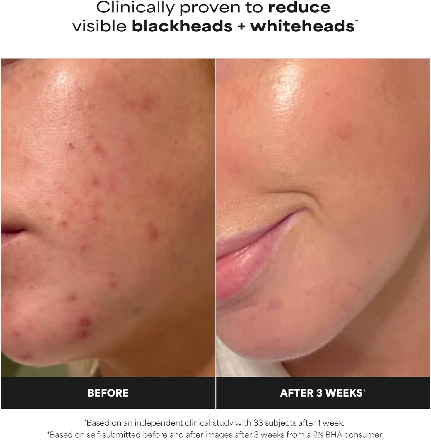 Before and after comparison of skin with blackheads and whiteheads, clinically proven to reduce them.