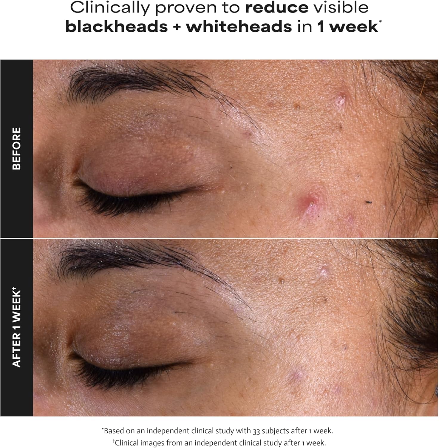 Before and after comparison of skin with blackheads and whiteheads, clinically proven to reduce them in 1 week.